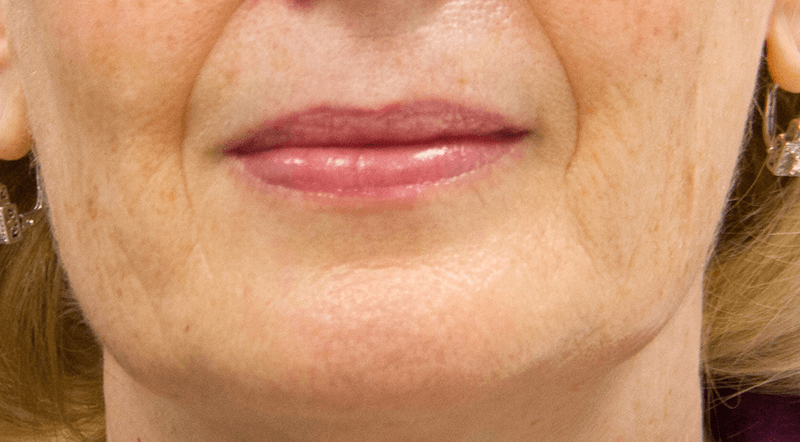 DermaKinetics skin after topical infusion