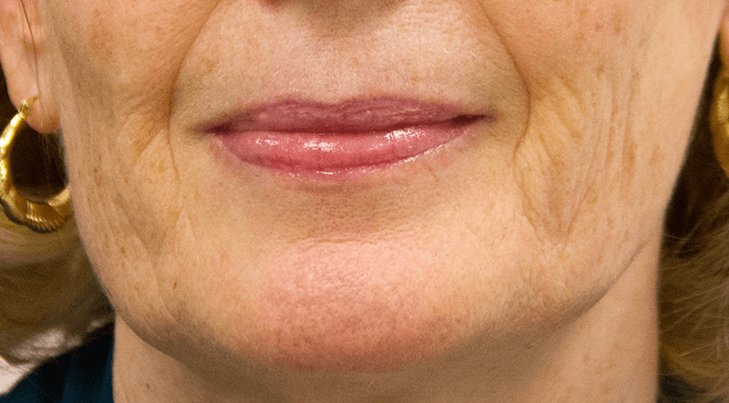 DermaKinetics skin before topical infusion